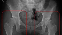 Pelvic X-ray with both hip joints circled in red