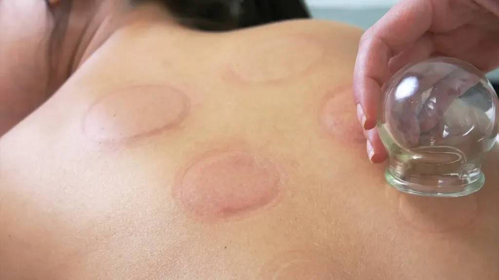 Close-up of cupping therapy marks on a person's upper back with a glass cup being placed